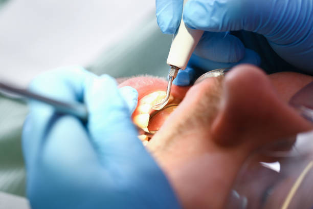 Best Emergency Denture Repair in Punta Rassa, FL