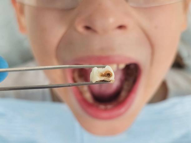 Best Emergency Wisdom Teeth Removal in Punta Rassa, FL